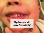 My three year old has a brown tooth!
