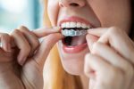 Everything you need to know if you are considering Invisalign braces