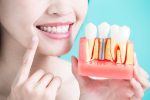 How do Dental Implants work?