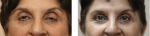 Ptosis surgery: what to expect before and after the procedure