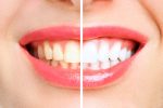 8 impressive benefits of teeth whitening that you can’t overlook